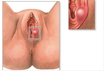 Glándulas de Bartholino: Todo lo que necesitas saber para cuidar tu bienestar íntimo